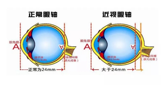 近视了,为什么要测眼轴呢?