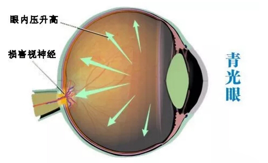 预防青光眼的6个建议及2个应避免的习惯