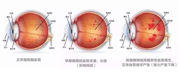 糖尿病患者失明率已超常人25倍？真相在这里！