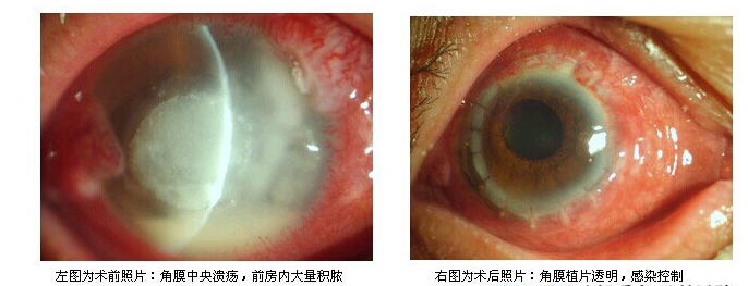 植物外伤不容忽视 谨防真菌性角膜溃疡