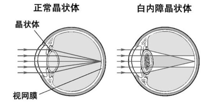 药物性白内障