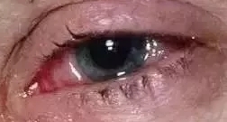 红眼病，真的是看一眼就会被传染了吗？